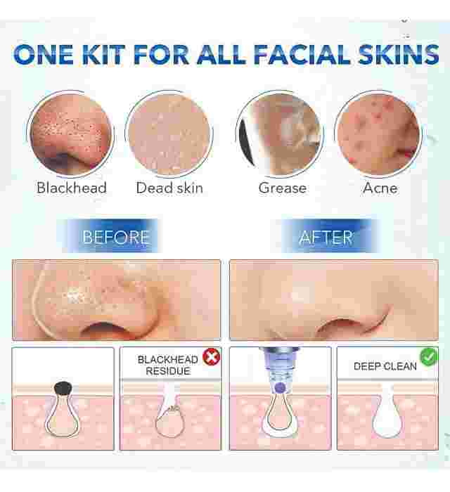 DERMA-SUCTION-8.jpg